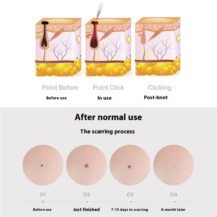 Home Electric Nevus Removal Pen Beauty Machine with 15 Intensity Modes